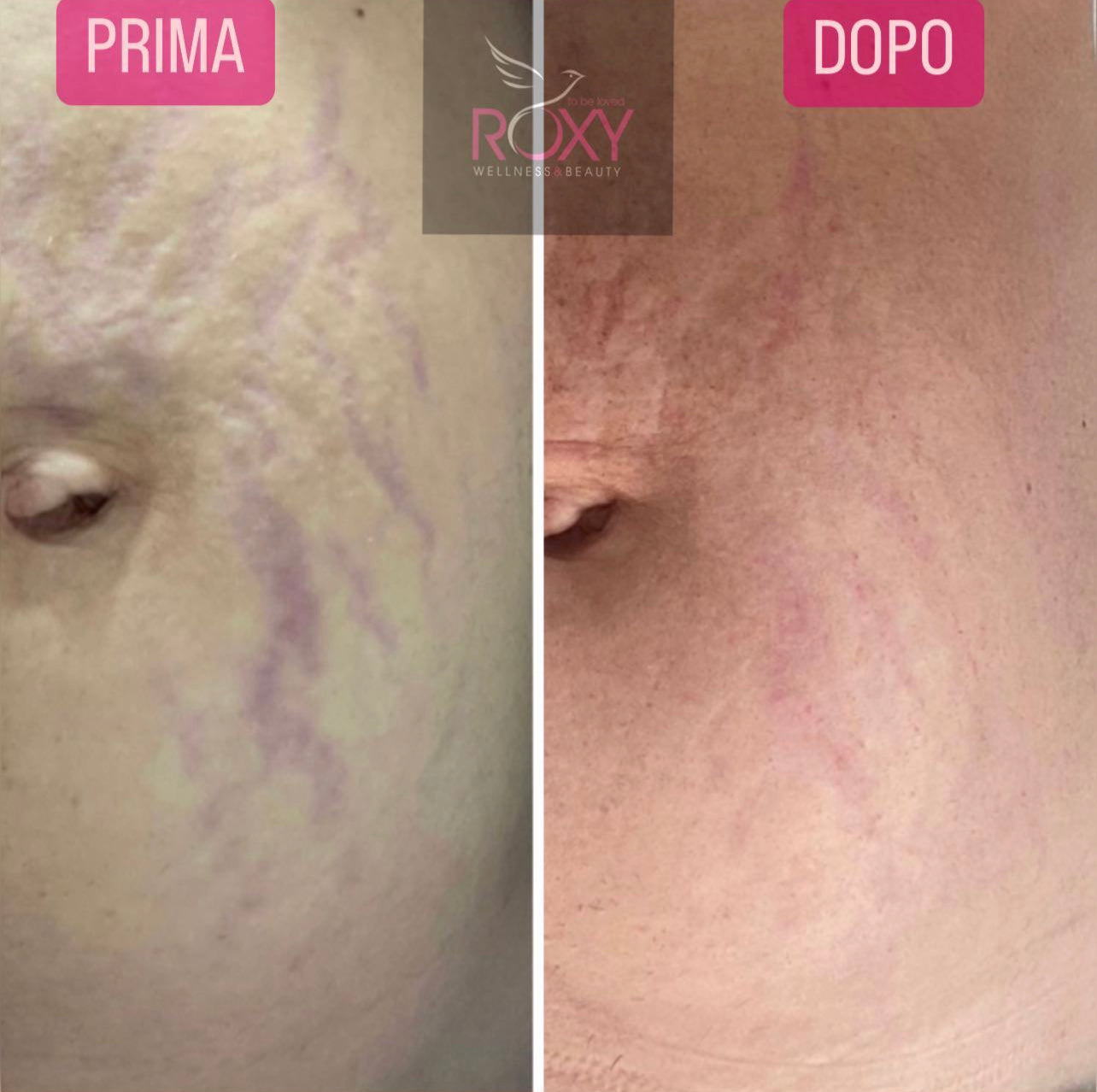 TESLA-MED PER SMAGLIATURE