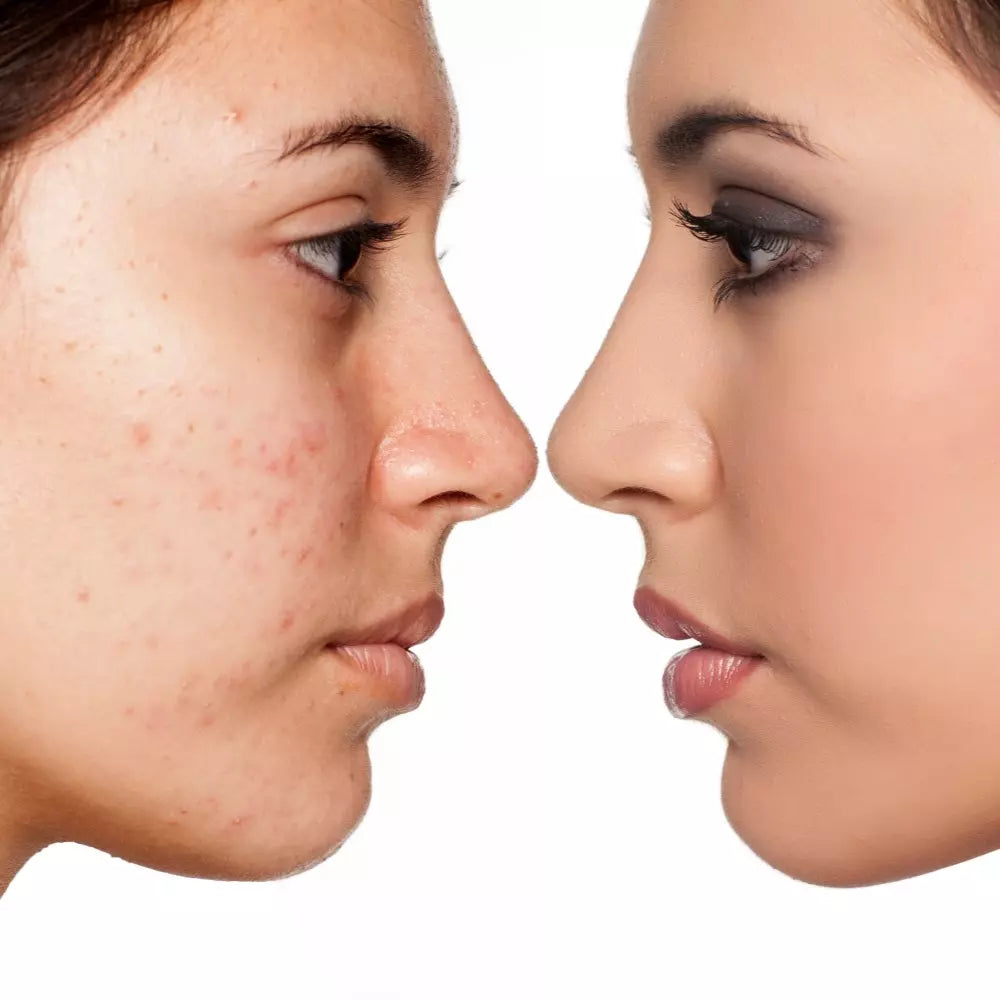 TESLA-MED PER PELLI ACNEICHE